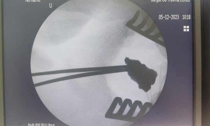 Сургутские хирурги удалили осколок снаряда у бойца СВО
